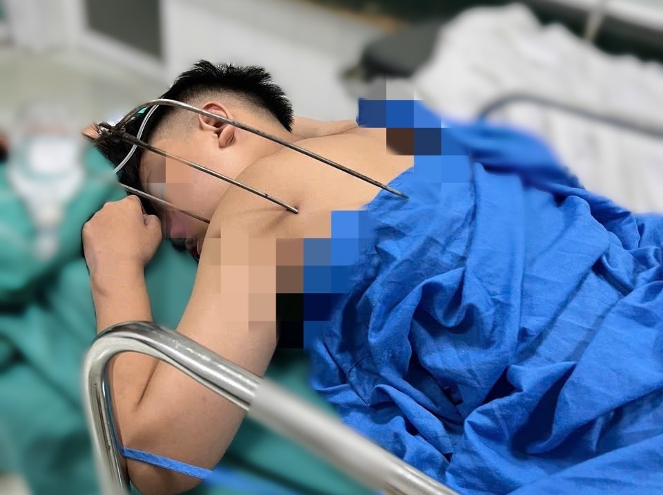 Cứu sống nam thanh niên bị dị vật kim loại tự chế xuyên thấu tim
